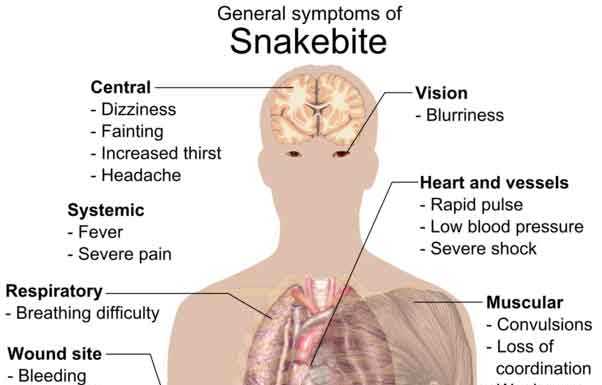 Information and Treatment for Snake Bite Snakebite Symptoms