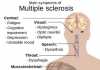 multiple sclerosis